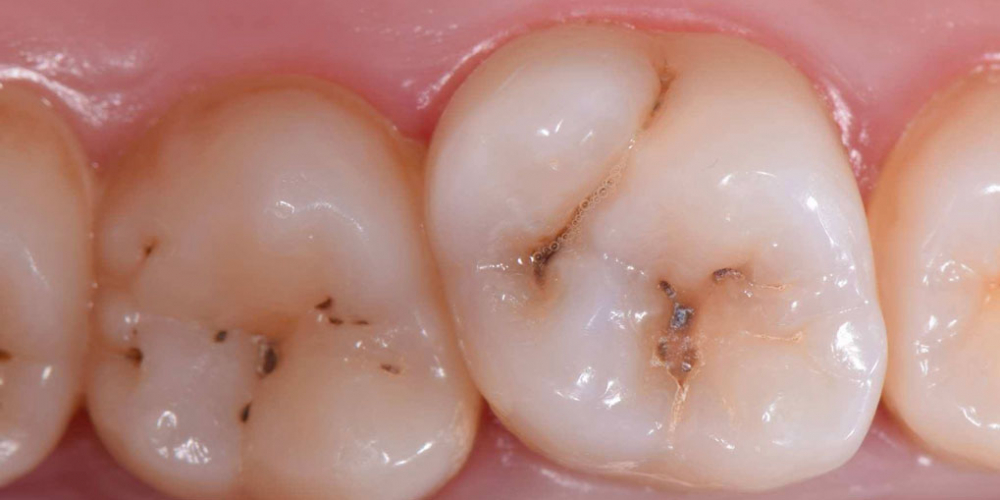 Фото до лечения. Лечение кариеса 1.6 и 1.7 зубов