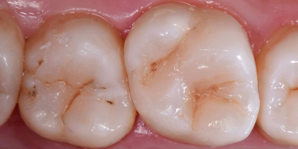 Фото после лечения. Лечение кариеса 1.6 и 1.7 зубов