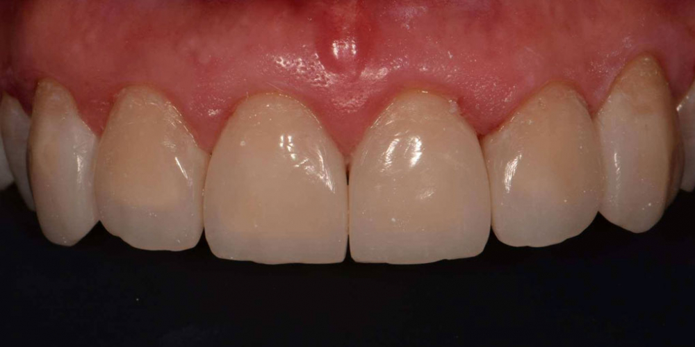  Эстетическая реабилитация фронтальной группы зубов методом прямой композитной реставрации