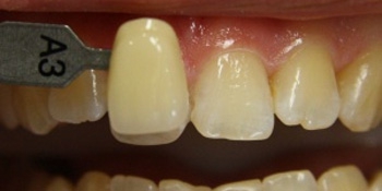 Отбеливание зубов фото до лечения