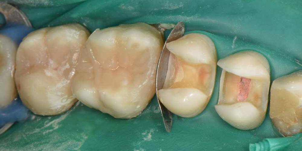  Реабилитация жевательной группы зубов