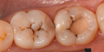 Лечение вторичного кариеса и прямая реставрация 3.6 и 3.7 зуба материалом Estelite Asteria фото до лечения