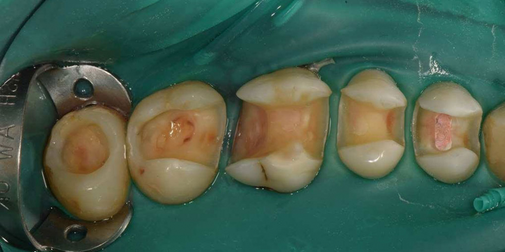  Реабилитация жевательной группы зубов