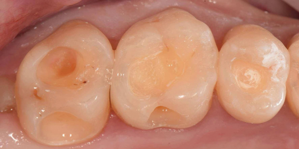  Реставрация трех жевательных зубов