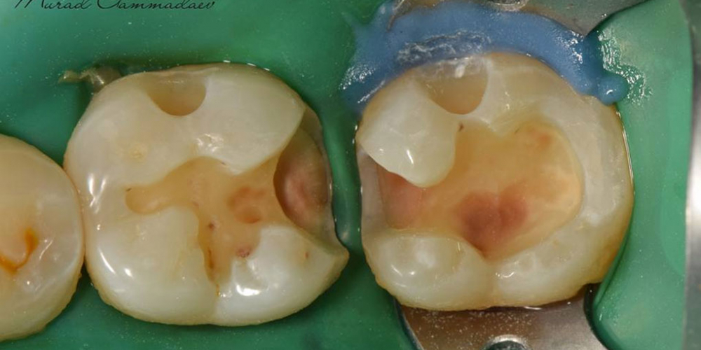  Лечение вторичного кариеса и прямая реставрация 3.6 и 3.7 зуба материалом Estelite Asteria