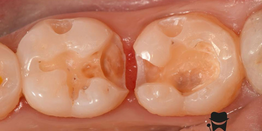  Лечение вторичного кариеса и прямая реставрация 3.6 и 3.7 зуба материалом Estelite Asteria
