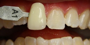 Отбеливание зубов фото после лечения