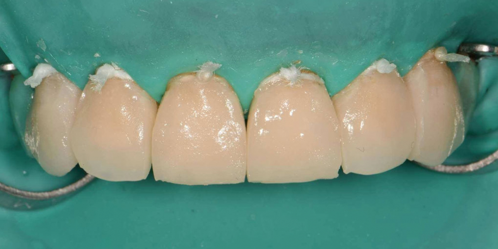  Эстетическая реабилитация фронтальной группы зубов методом прямой композитной реставрации