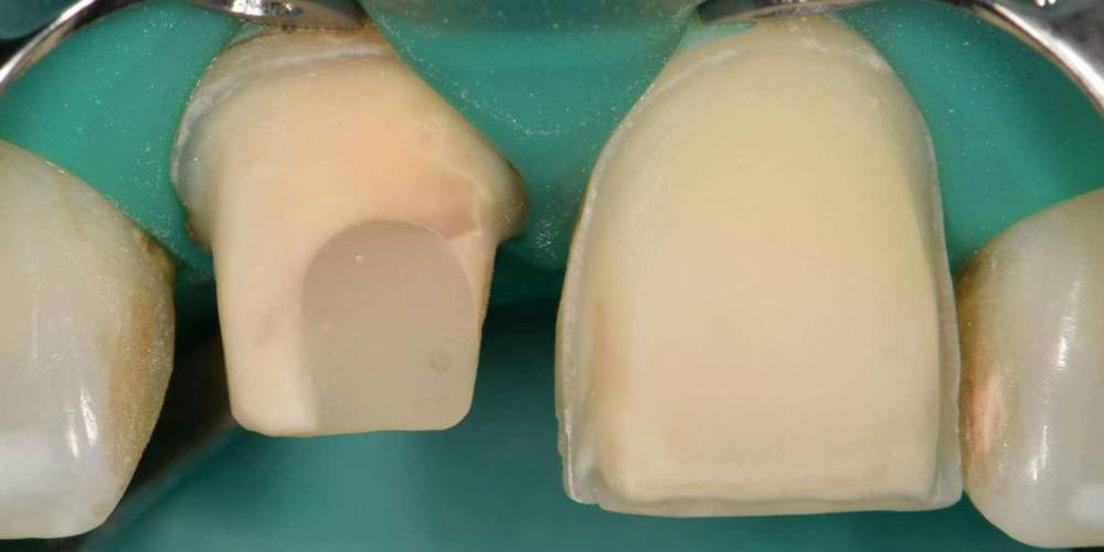  Эстетическая реабилитация центральных резцов верхней челюсти цельнокерамическими реставрациями e max