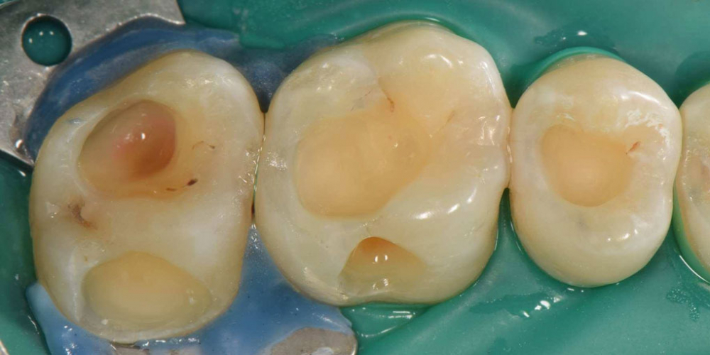  Реставрация трех жевательных зубов